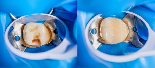 Zwei Bilder eines Zahns - Links mit Löchern und rechts der gleich Zahn mit Füllung