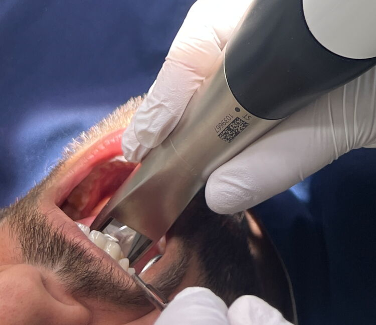 Nahaufnahme einer Mundhöhle während einer CEREC Behandlung mit entsprechendem Gerät