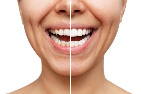Frontalansicht eines weiblichen Gesichts mit Splitscreen der Schneidezähne - Links vorher - Rechts mit aufgesetzten Vaneers