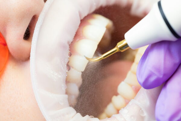 Blick in einen geöffneten Mundraum während einer professionellen Zahnreinigung