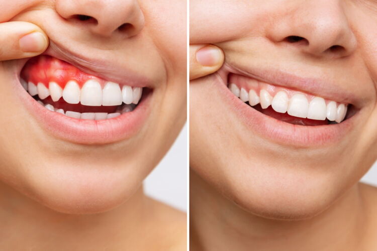 Blick auf entzündetes Zahnfleisch vor und nach einer Behandlung